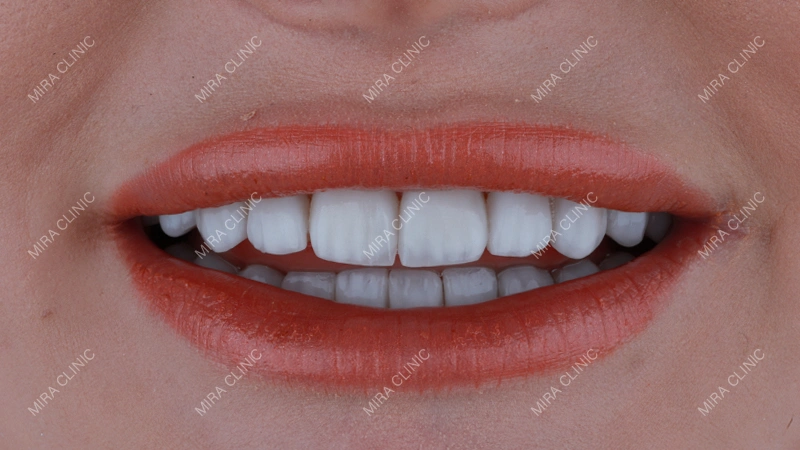 Hollywood Smile